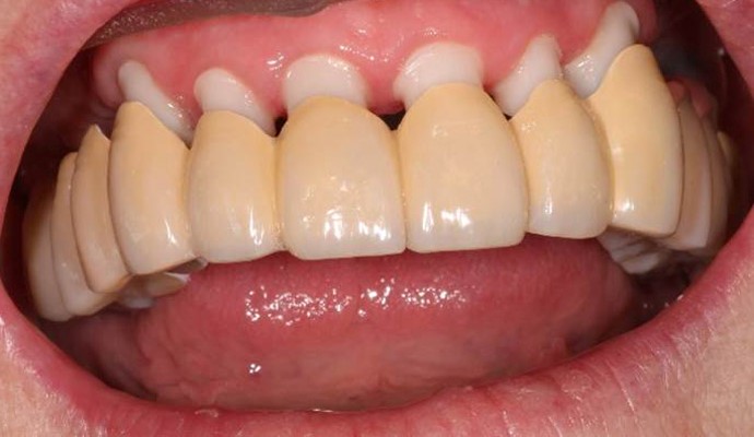 Wax Try In 
      Dentures Derby Line VT 5830